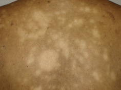 Hipopigmentasi Pasca Inflamasi